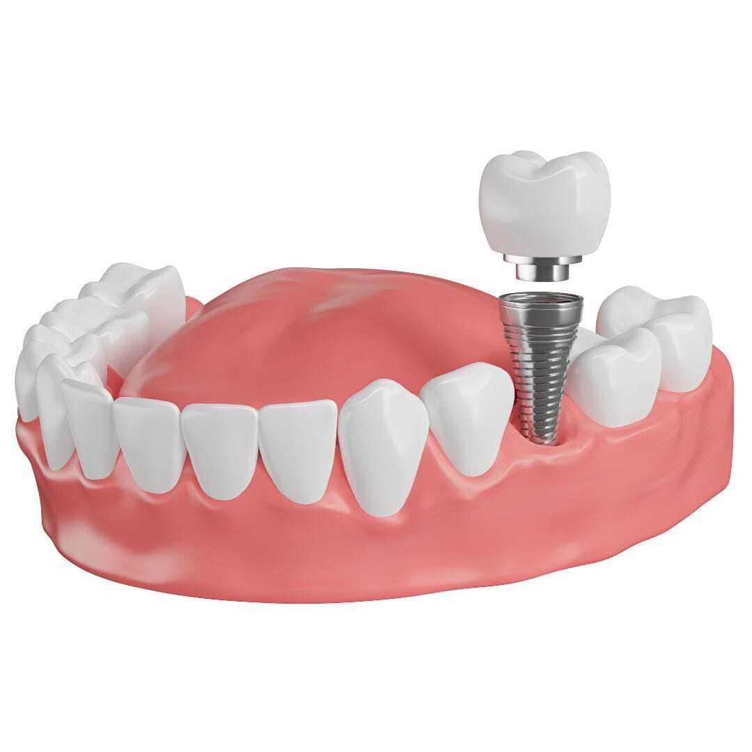 Choosing dental implants - Conclusion: Making an Informed Decision About Dental Implants in Gurgaon (2)