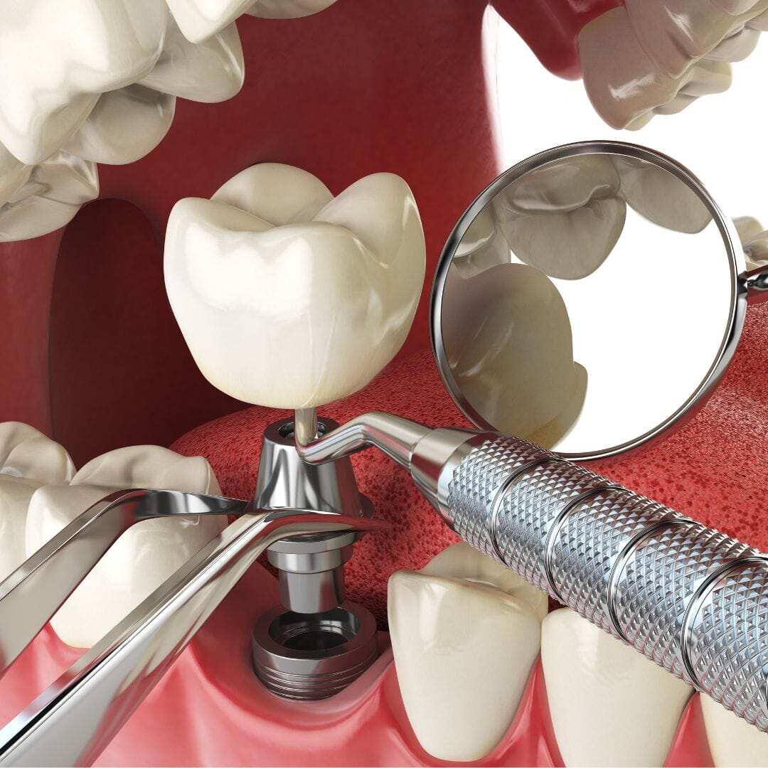 Choosing dental implants - Conclusion: Making an Informed Decision About Dental Implants in Gurgaon (3)