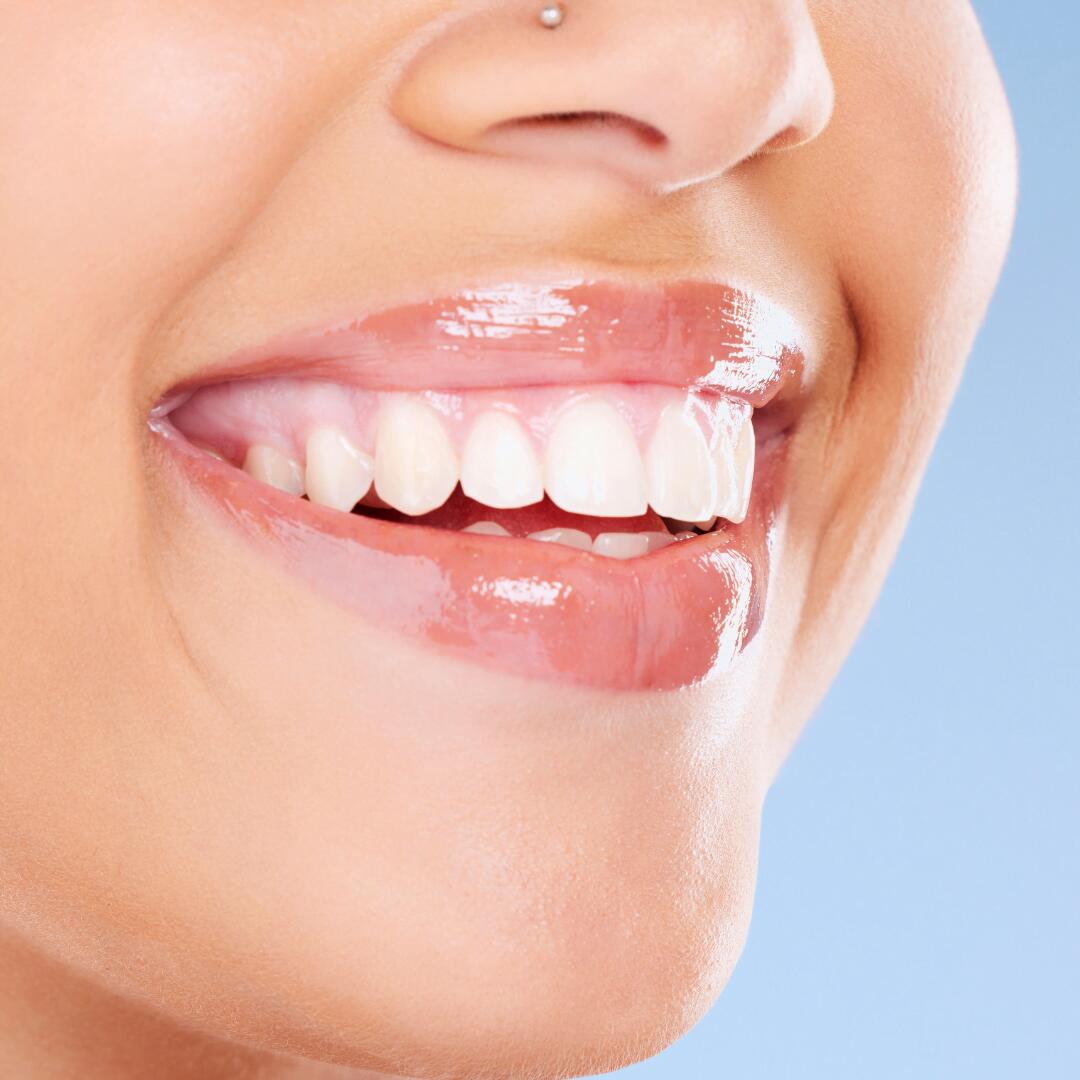 Dental veneers - Veneer Fitting