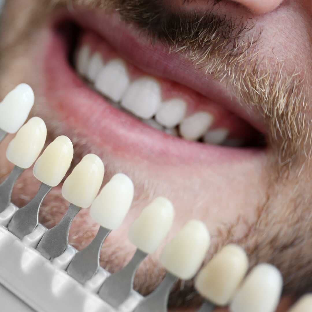 Dental veneers - Veneer Fitting (3)