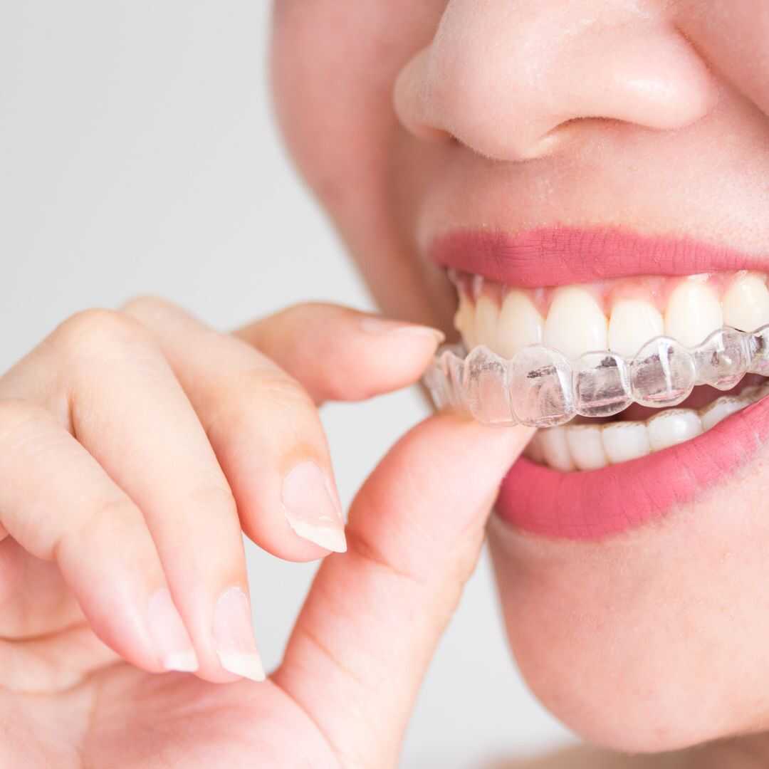 Invisalign oral hygiene - Conslusion (3)