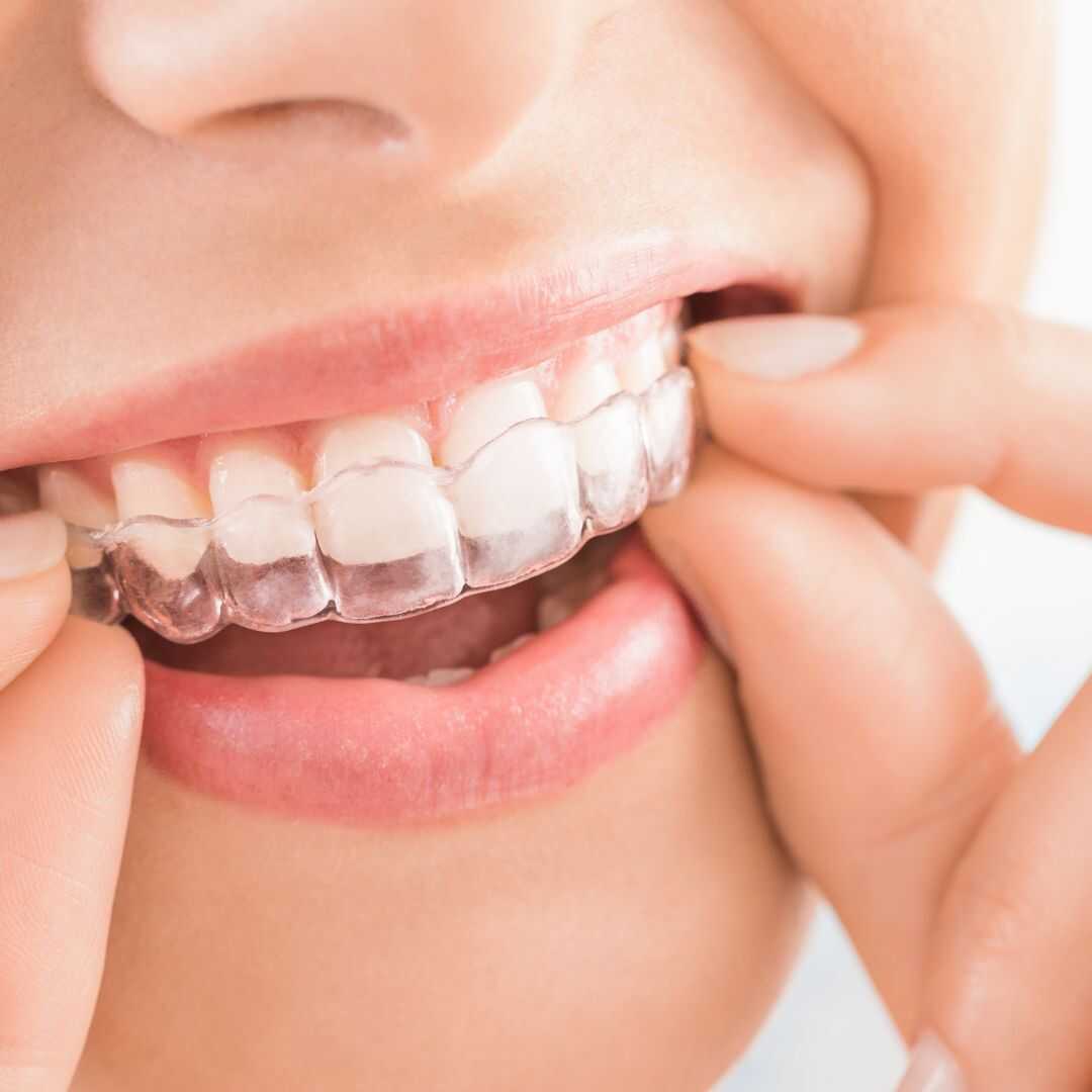 Invisalign oral hygiene - Conslusion (4)