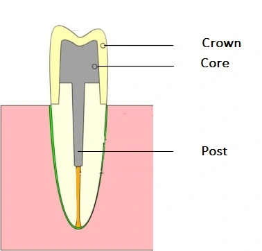 Post and core technique