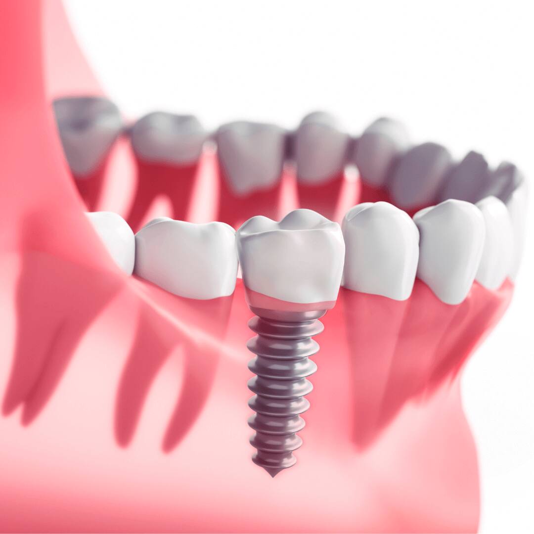 Removing a dental implant - Preventing Dental Implant Removal