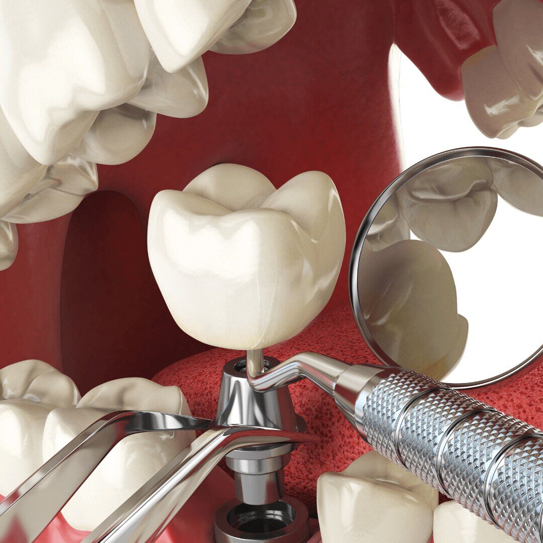 Removing a dental implant - Preventing Dental Implant Removal (2)