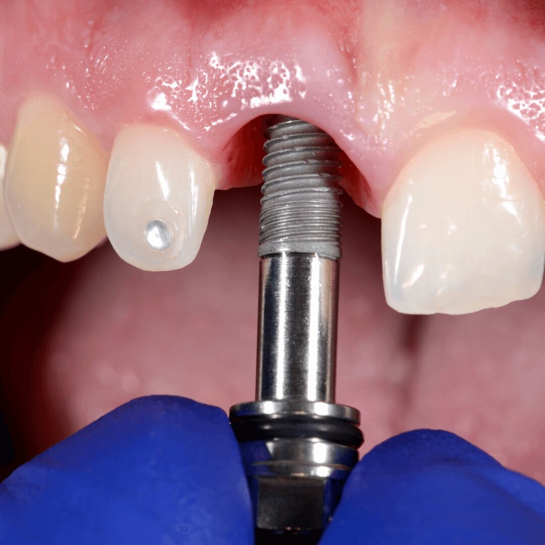 Removing a dental implant - Preventing Dental Implant Removal (3)