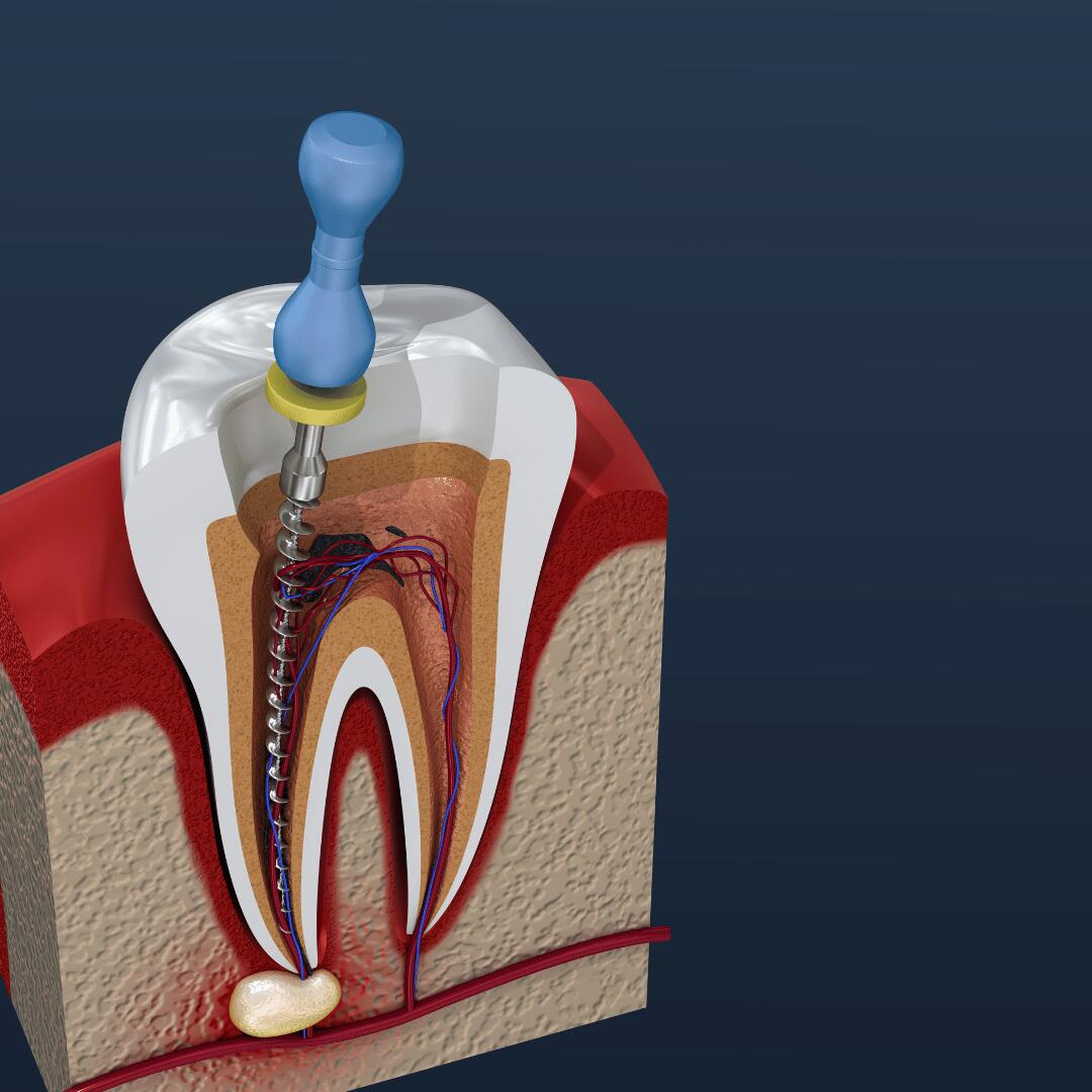 Root canal vs extraction - Recovery and Long-Term Benefits