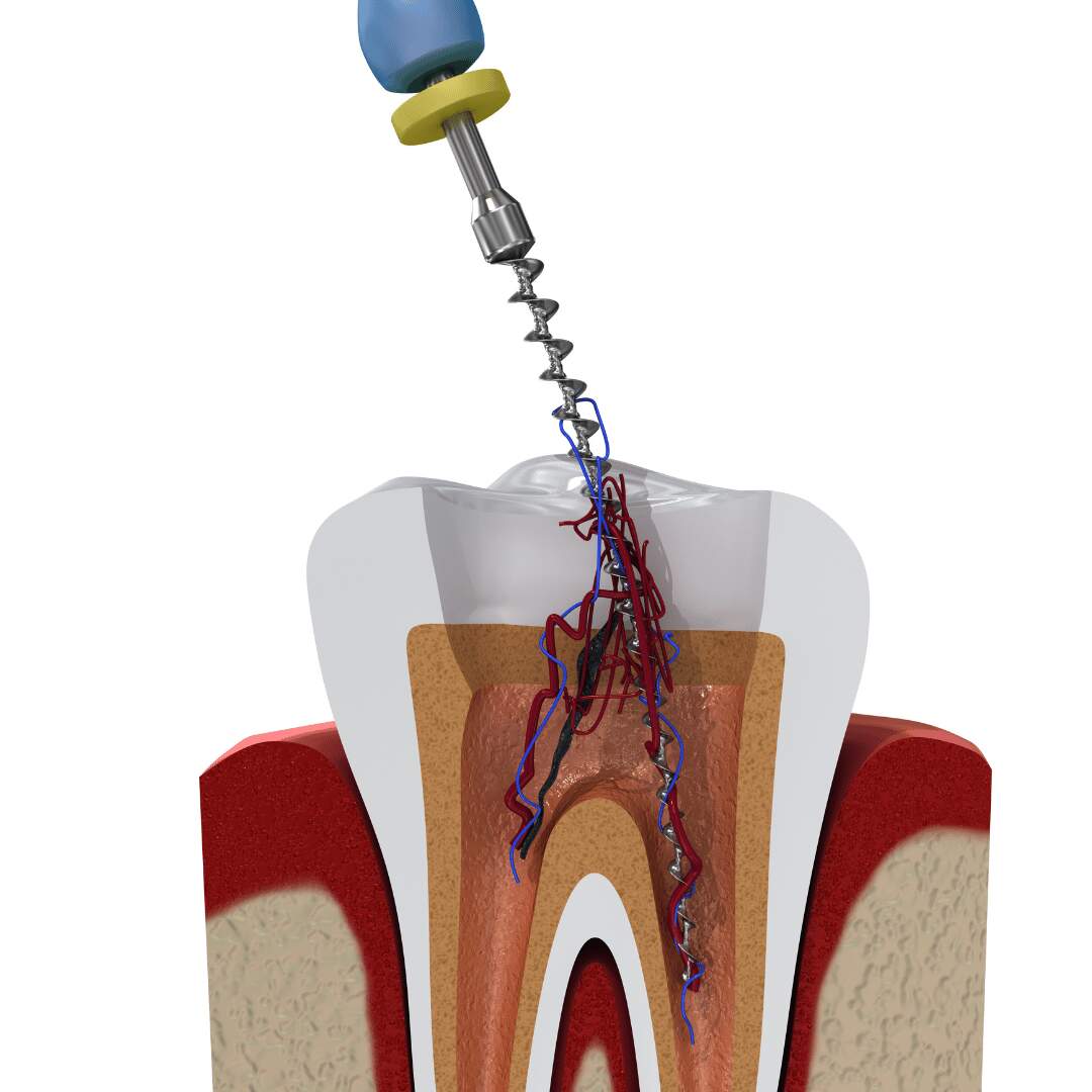 Root canal vs extraction - Recovery and Long-Term Benefits (2)
