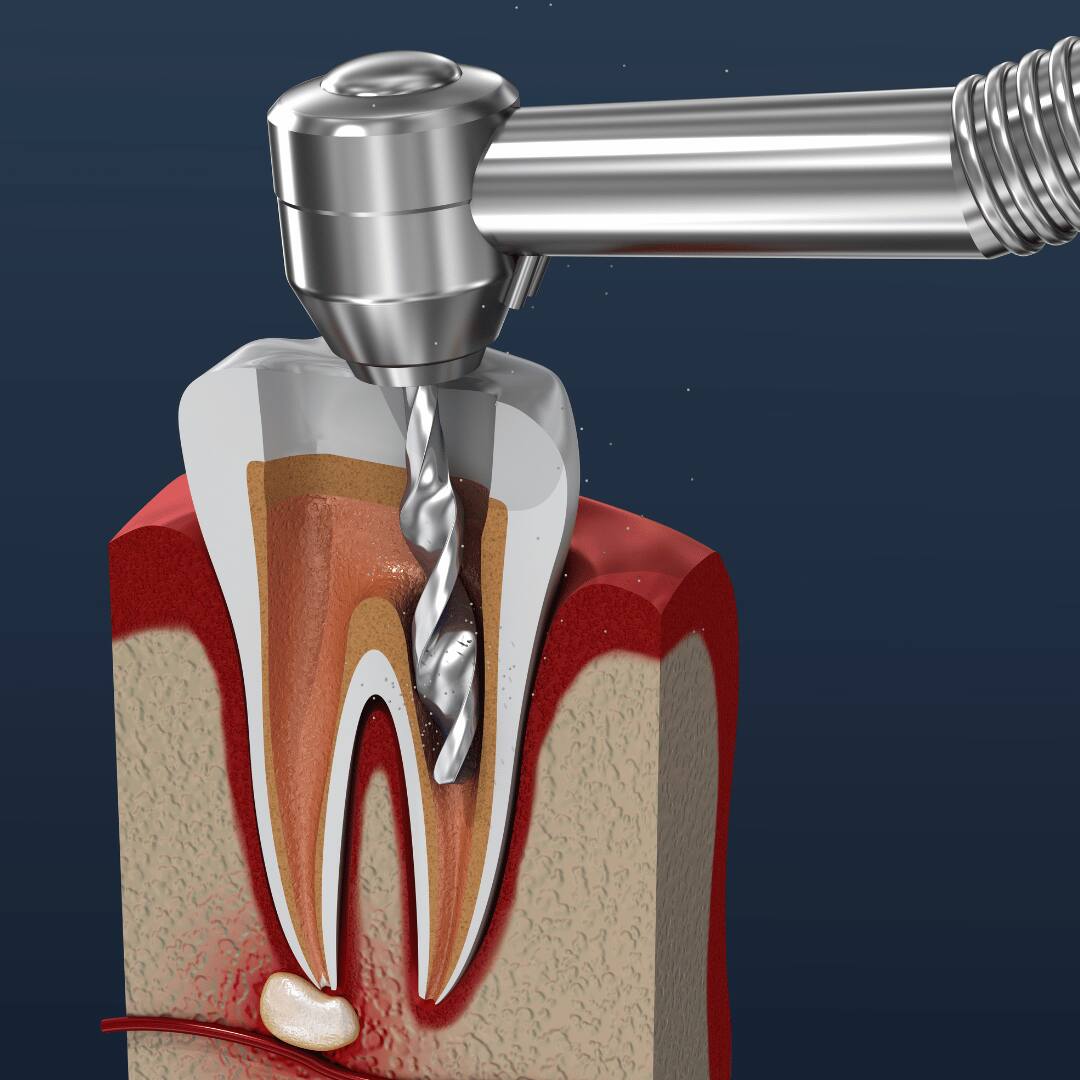 Root canal vs extraction - Recovery and Long-Term Benefits (3)