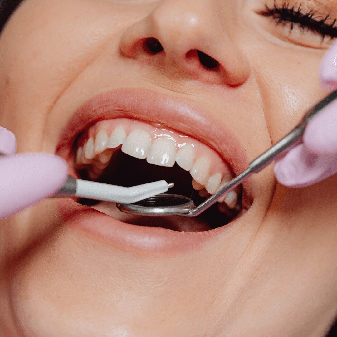 Teeth whitening guide - Maintaining a Bright Smile