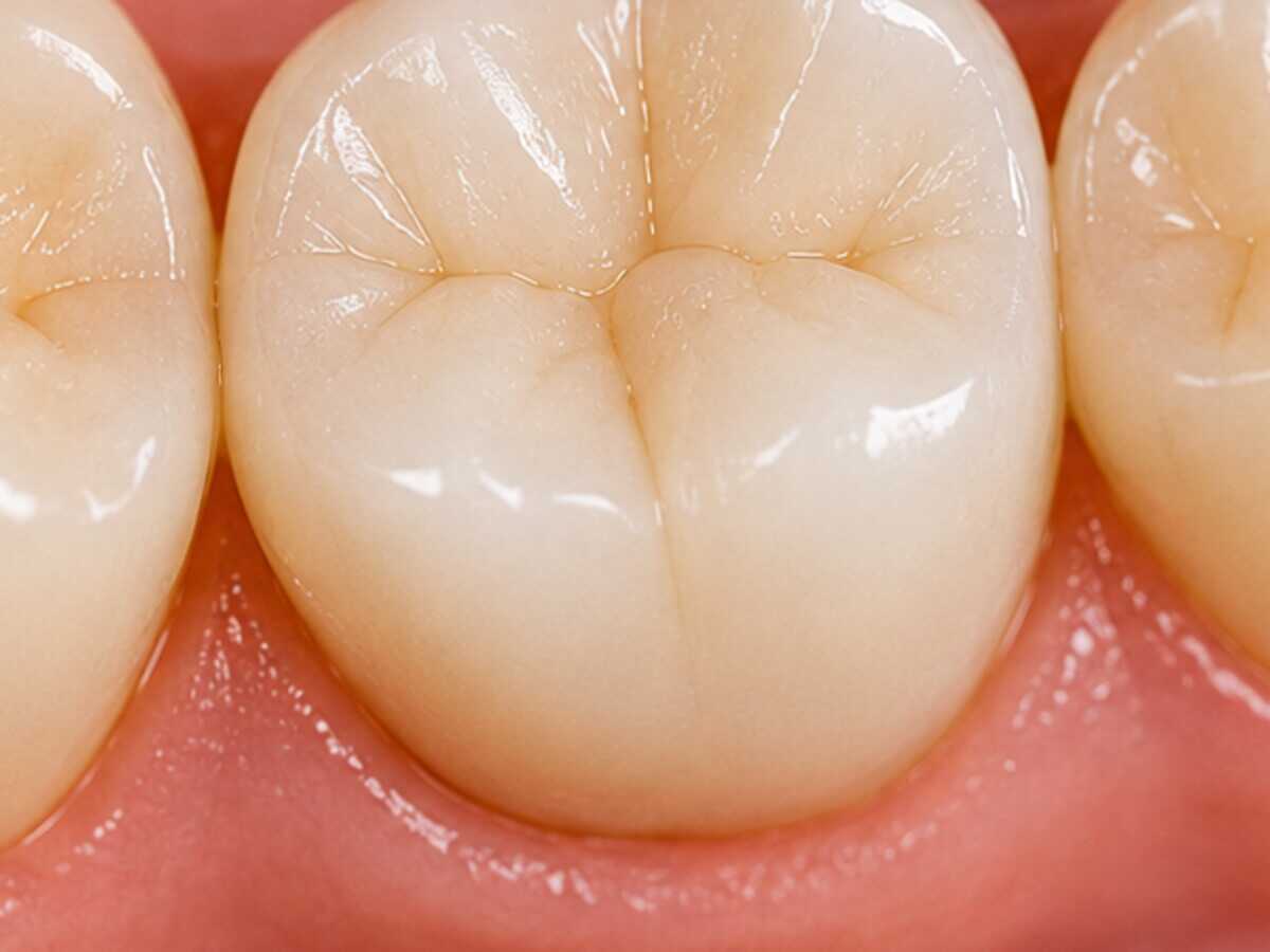 The same molar restored with a ceramic dental crown