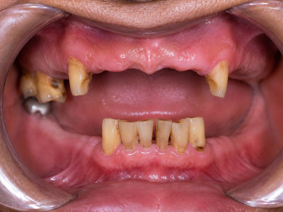 A mouth with only a few badly decayed teeth remaining in the upper and lower jaws, before treatment