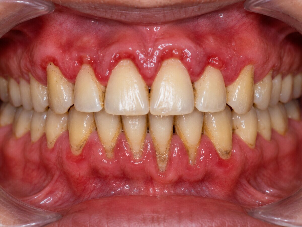 Swollen, inflamed gums with heavy tartar deposits along the gum line, before periodontal treatment