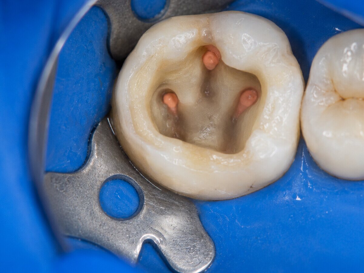 The same molar after retreatment, with the canals located, cleaned and resealed