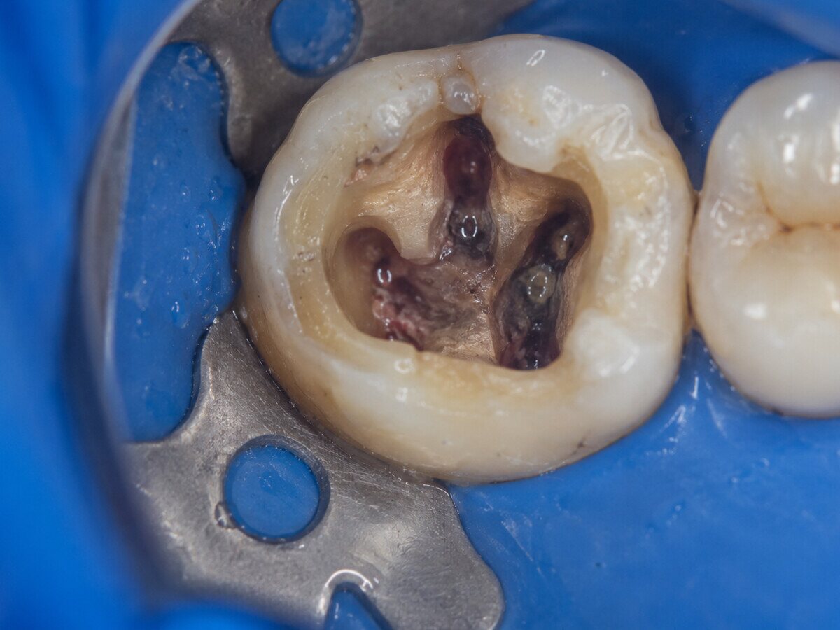 A molar isolated under rubber dam, showing the old infected root canal filling before retreatment