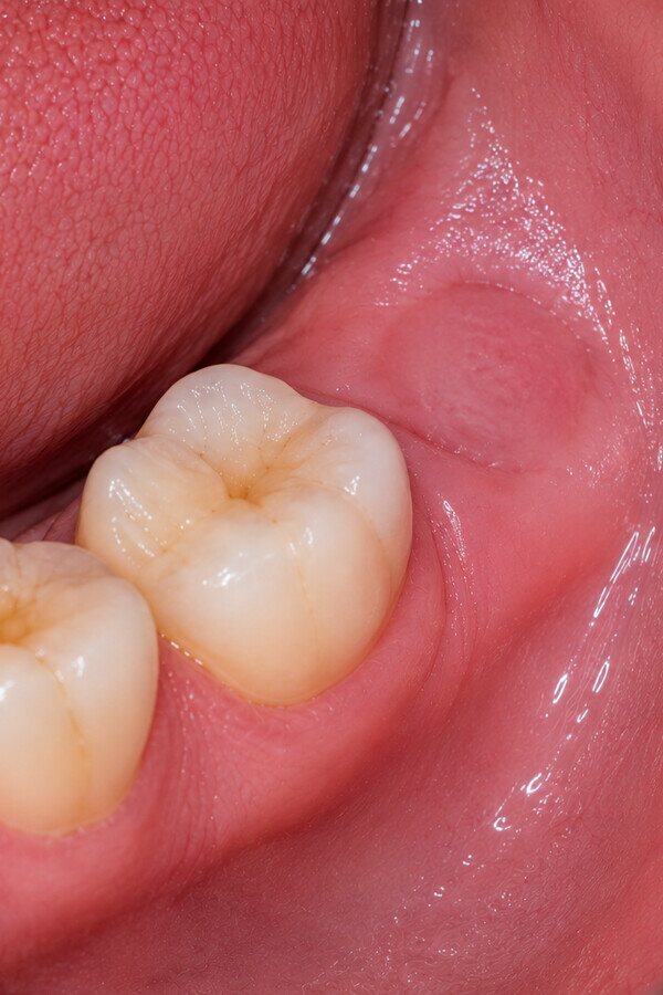 The same area healed after the wisdom tooth was removed