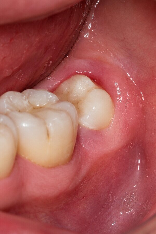 A partially erupted lower wisdom tooth with inflamed gum tissue around it, before extraction