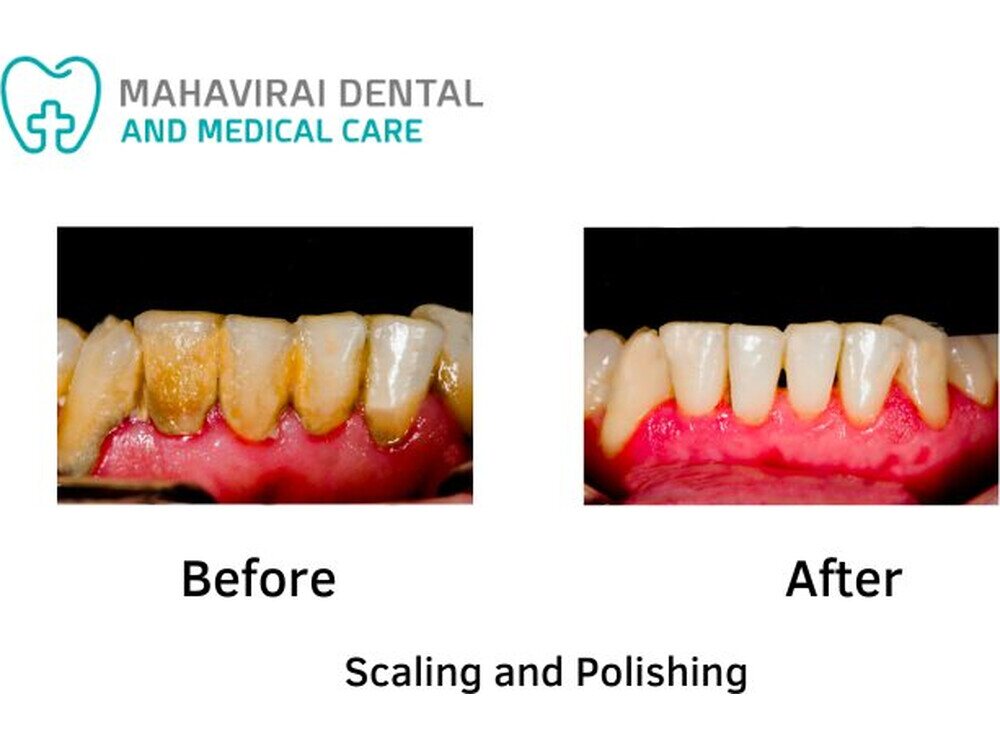 Before and after photographs of scaling and polishing at Mahavirai Dental, Gurgaon